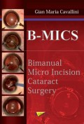 B-MICS BIMANUAL MICRO INCISION CATARACT SURGEY